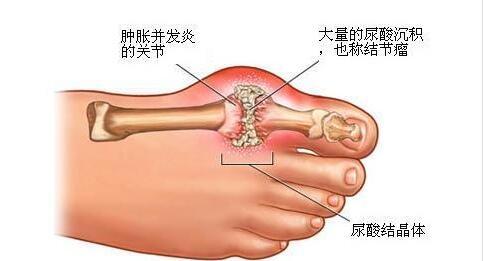 秋冬季节小心痛风，在饮食方面该注意些什么？