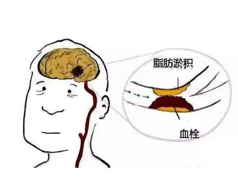 这些卒中信号是大脑最后的呼救