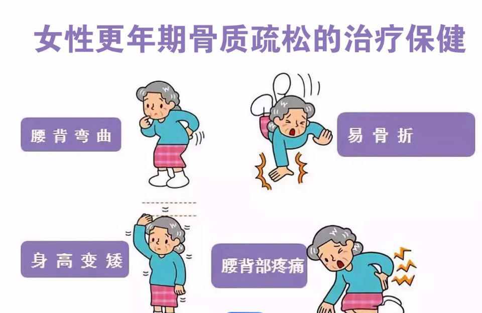 更年期女性易发骨质疏松
