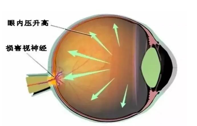 致盲率极高，青光眼呈现年轻化趋势