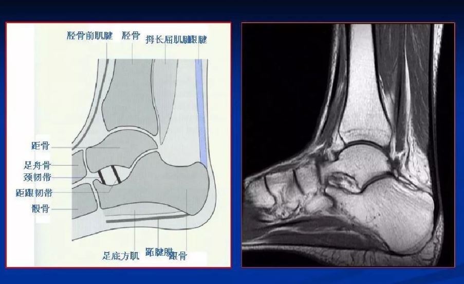 扭了脚脖子怎么还得做核磁？