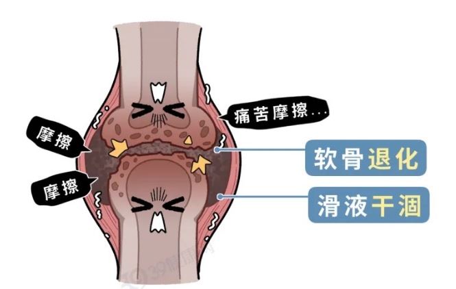 且行且珍“膝” 保护膝盖建议做好这几件事