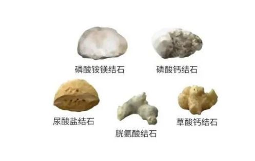 结石也分“门派”？成分不同，治法大不同！