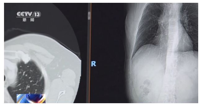 肺癌连续十年位居癌症死亡率首位专家提醒：CT“早筛”是关键