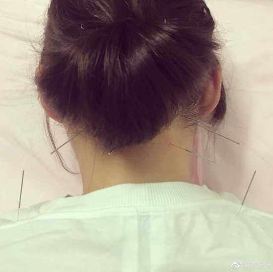 生病了？袁姗姗脖子扎满针做治疗惹人心疼