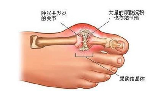 痛风不痛时 别不当回事